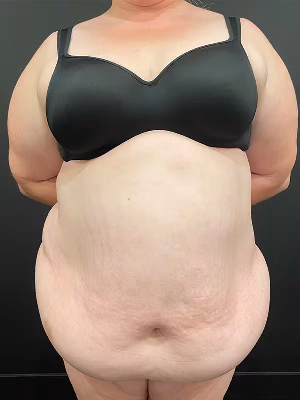 Before Image: Plus Size Tummy Tuck - front