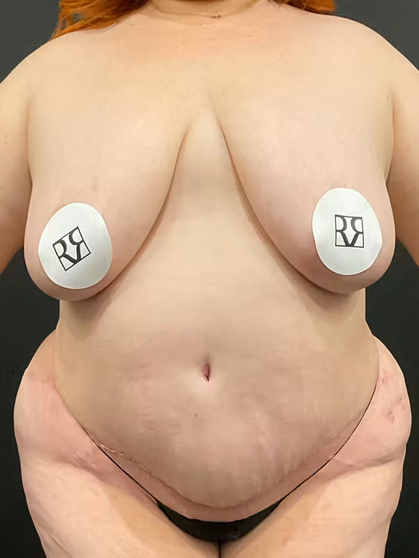 After Image: Plus Size Tummy Tuck - front