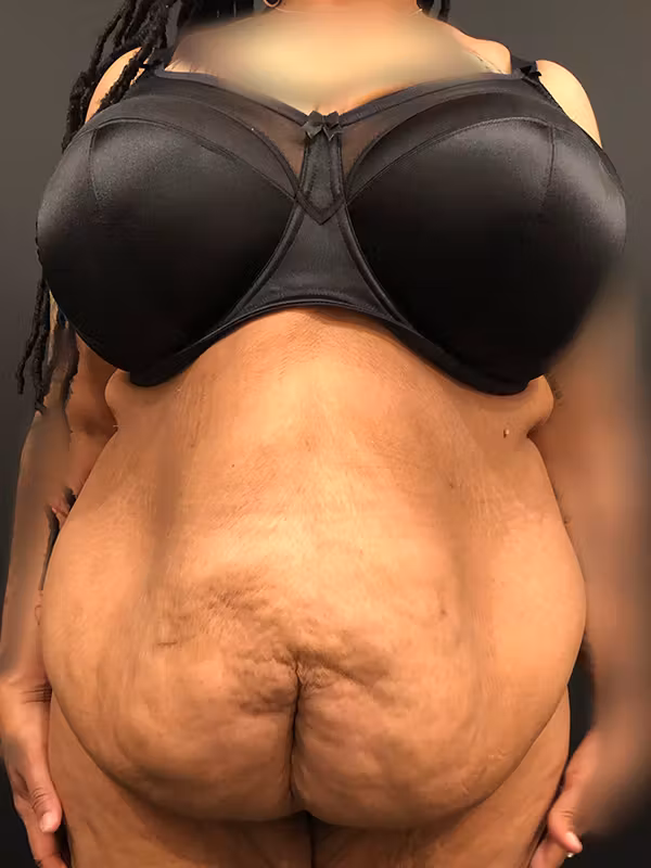 Before Image: Plus Size Tummy Tuck - front