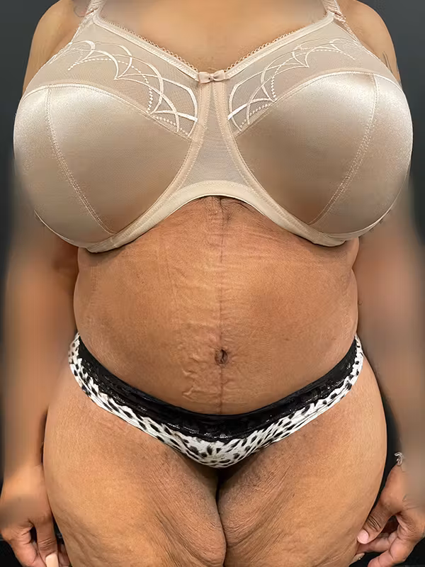 After Image: Plus Size Tummy Tuck - front