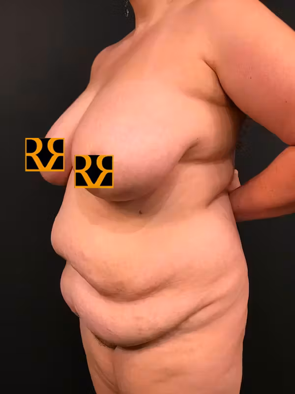 Before Image: Plus Size Tummy Tuck - left-front-oblique