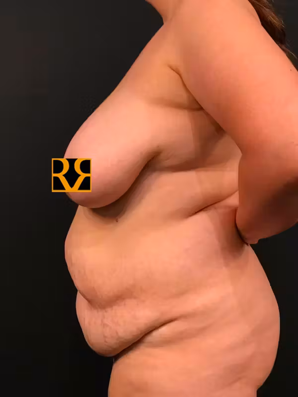 Before Image: Plus Size Tummy Tuck - left-side