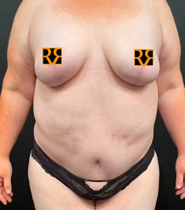 After Image: Plus Size Tummy Tuck - front