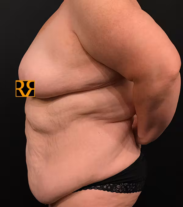 Before Image: Plus Size Tummy Tuck - left-side
