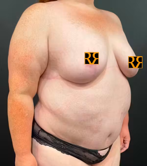 After Image: Plus Size Tummy Tuck - right-front-oblique