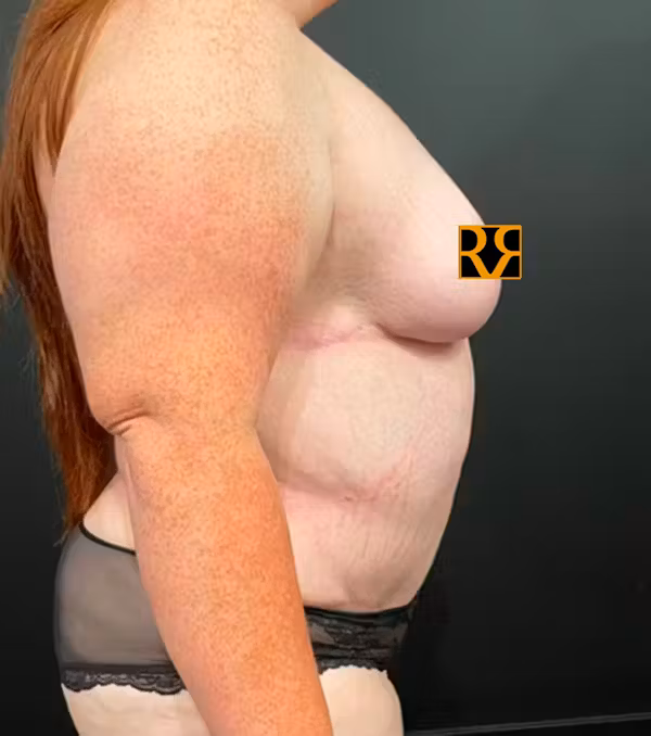 After Image: Plus Size Tummy Tuck - right-side