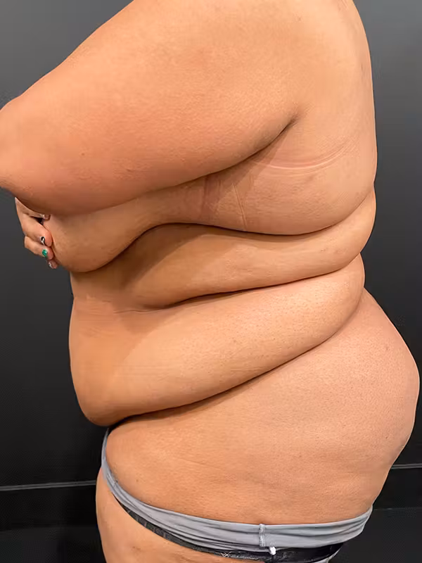 Before Image: Plus Size Tummy Tuck - left-side