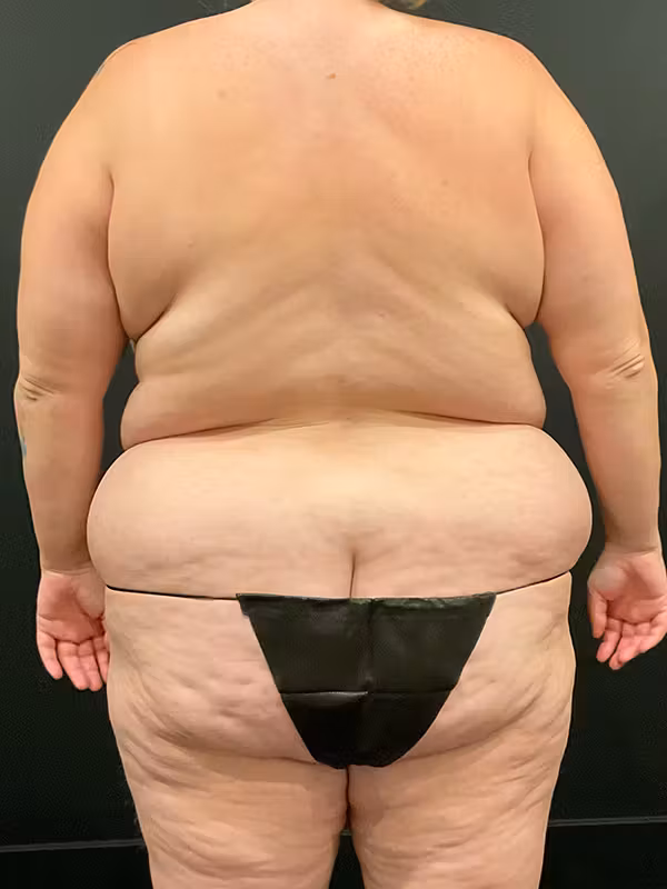 Before Image: Plus Size Tummy Tuck - back