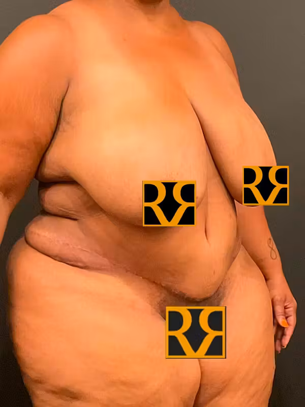 After Image: Plus Size Tummy Tuck - right-front-oblique