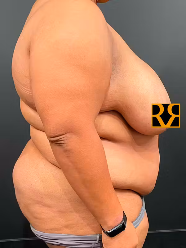 Before Image: Plus Size Tummy Tuck - right-side