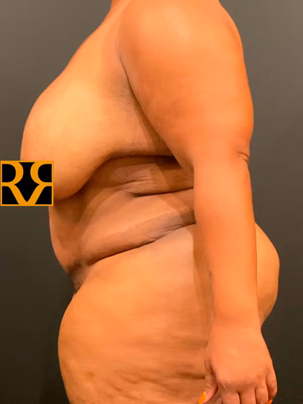 After Image: Plus Size Tummy Tuck - left-side