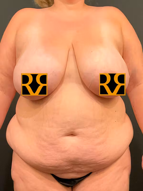 Before Image: Plus Size Tummy Tuck - front