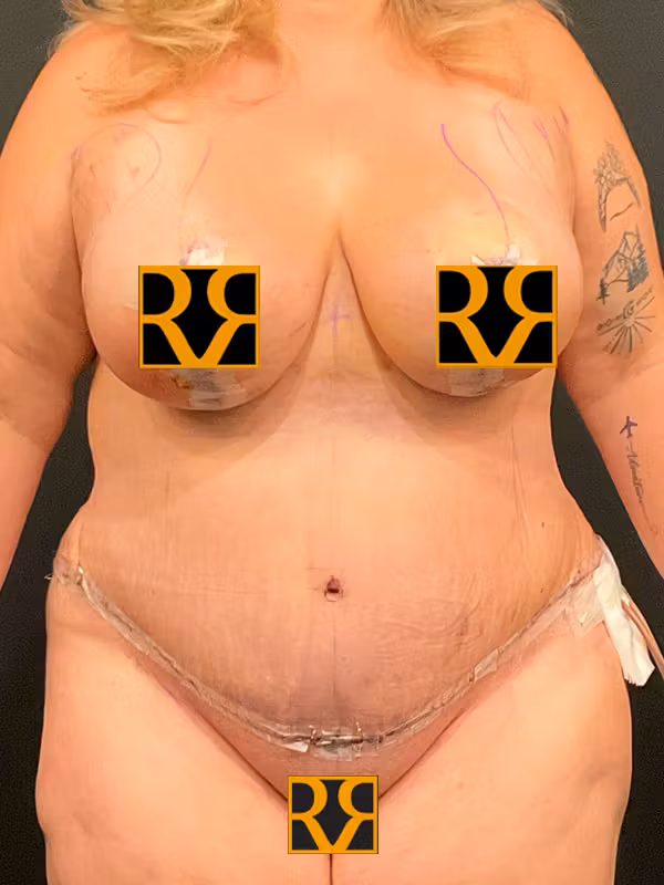 After Image: Plus Size Tummy Tuck - front