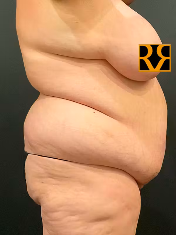 Before Image: Plus Size Tummy Tuck - right-side