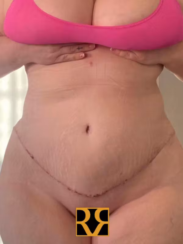 After Image: Plus Size Tummy Tuck - front