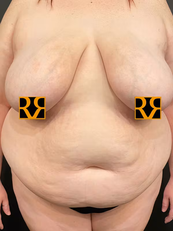 Before Image: Plus Size Tummy Tuck - front