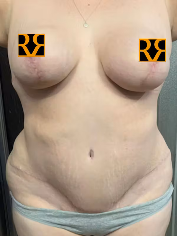 After Image: Plus Size Tummy Tuck - front