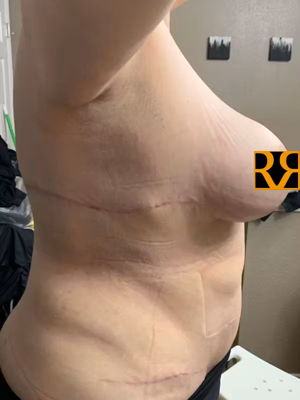 After Image: Plus Size Tummy Tuck - right-side