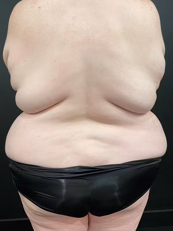 Before Image: Plus Size Tummy Tuck - back