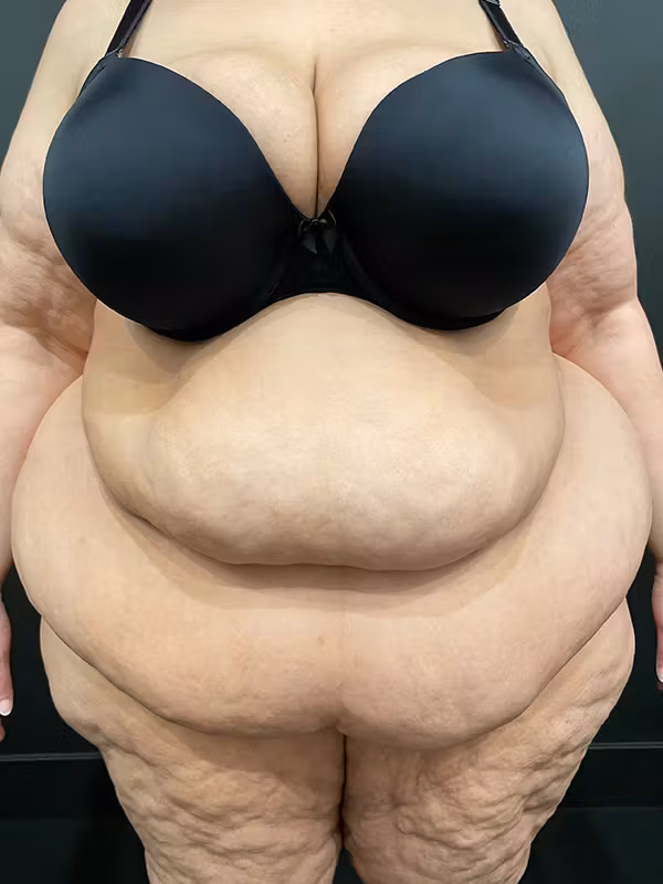 Before Image: Plus Size Tummy Tuck - front