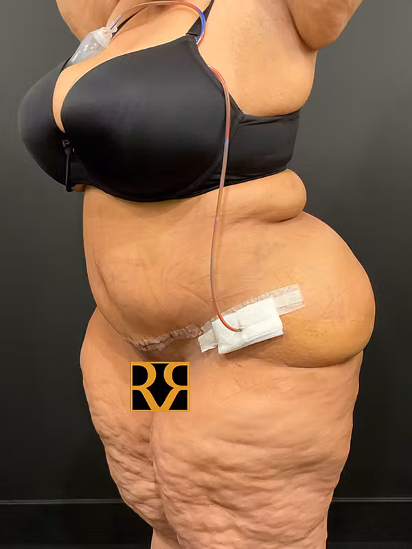 After Image: Plus Size Tummy Tuck - left-front-oblique