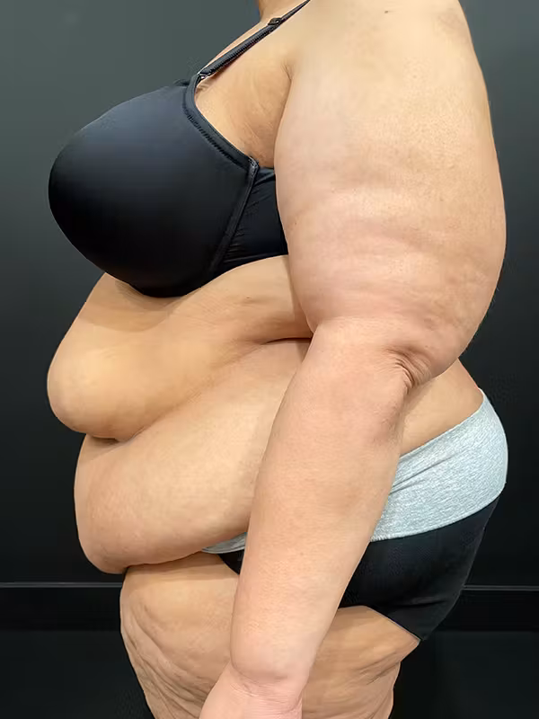 Before Image: Plus Size Tummy Tuck - left-side