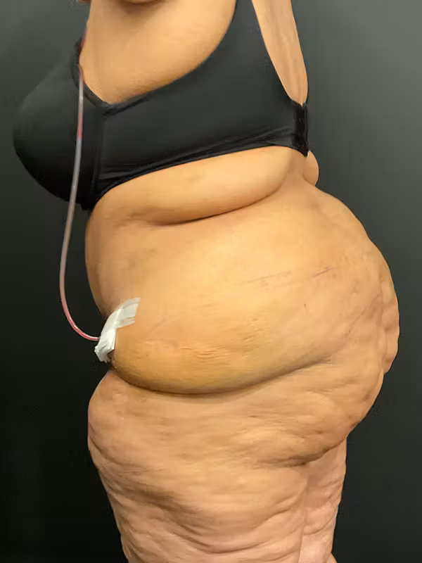 After Image: Plus Size Tummy Tuck - left-side