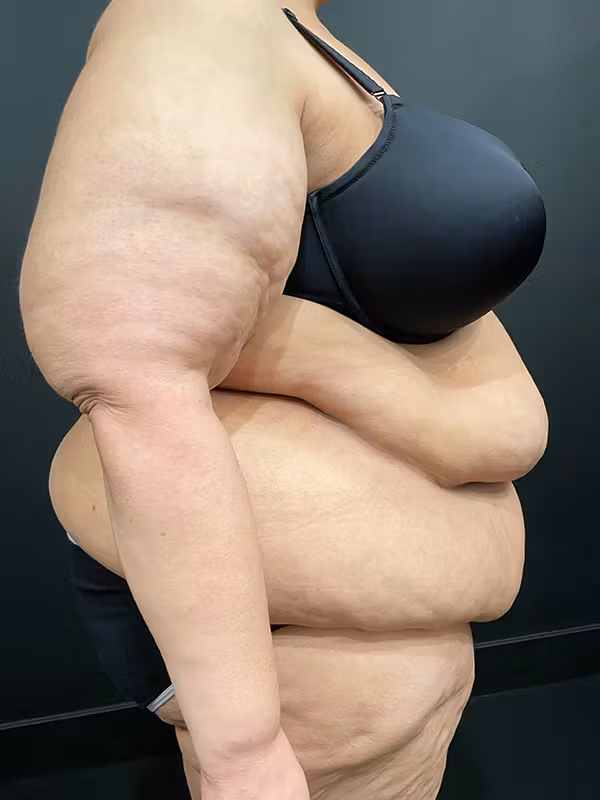 Before Image: Plus Size Tummy Tuck - right-side