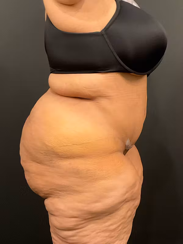 After Image: Plus Size Tummy Tuck - right-side