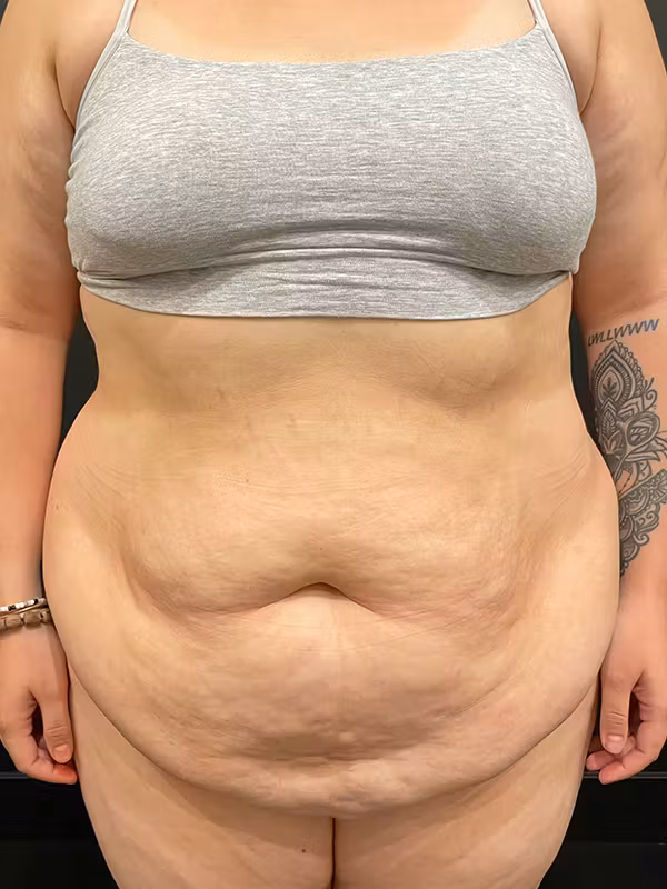 Before Image: Plus Size Tummy Tuck - front