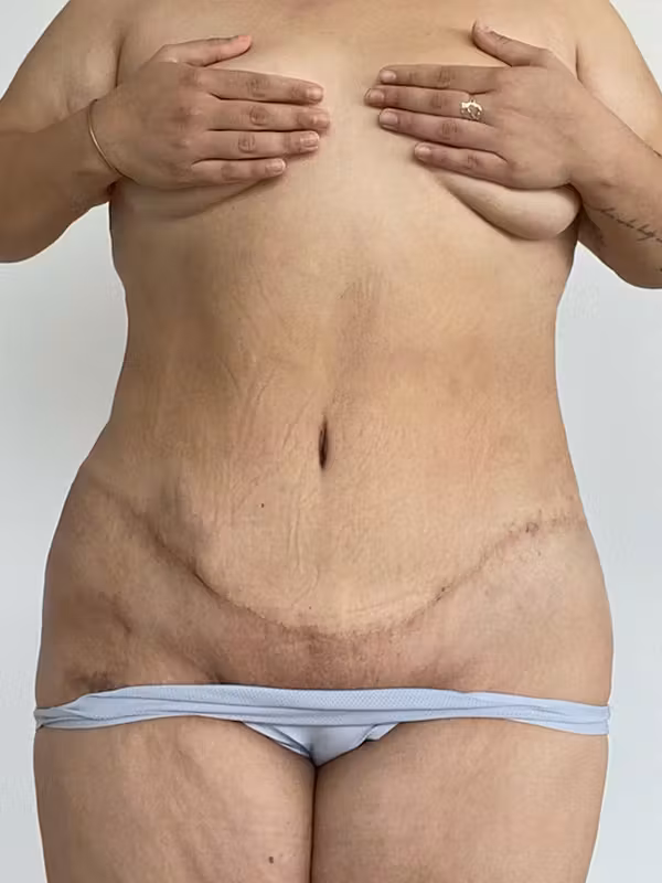 After Image: Plus Size Tummy Tuck - front