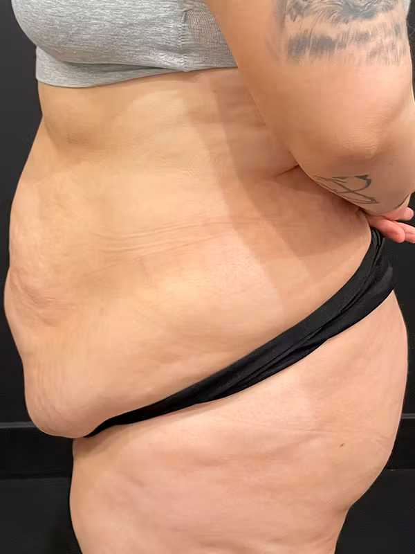 Before Image: Plus Size Tummy Tuck - left-side