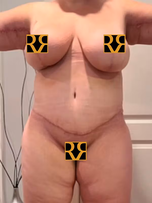 After Image: Plus Size Tummy Tuck - front