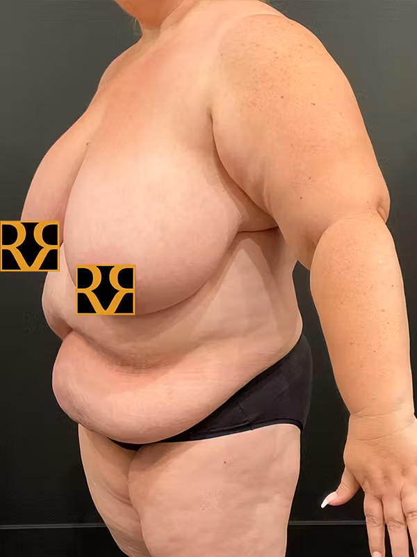 Before Image: Plus Size Tummy Tuck - left-front-oblique