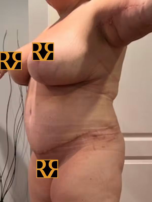 After Image: Plus Size Tummy Tuck - left-front-oblique