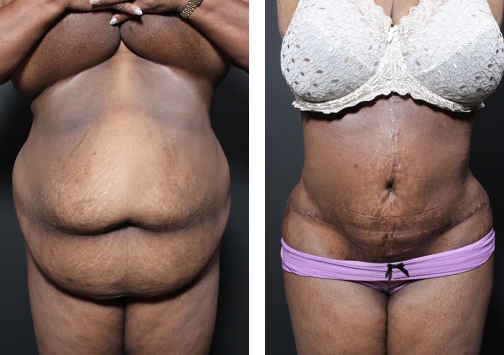 before and after plus size tummy tuck