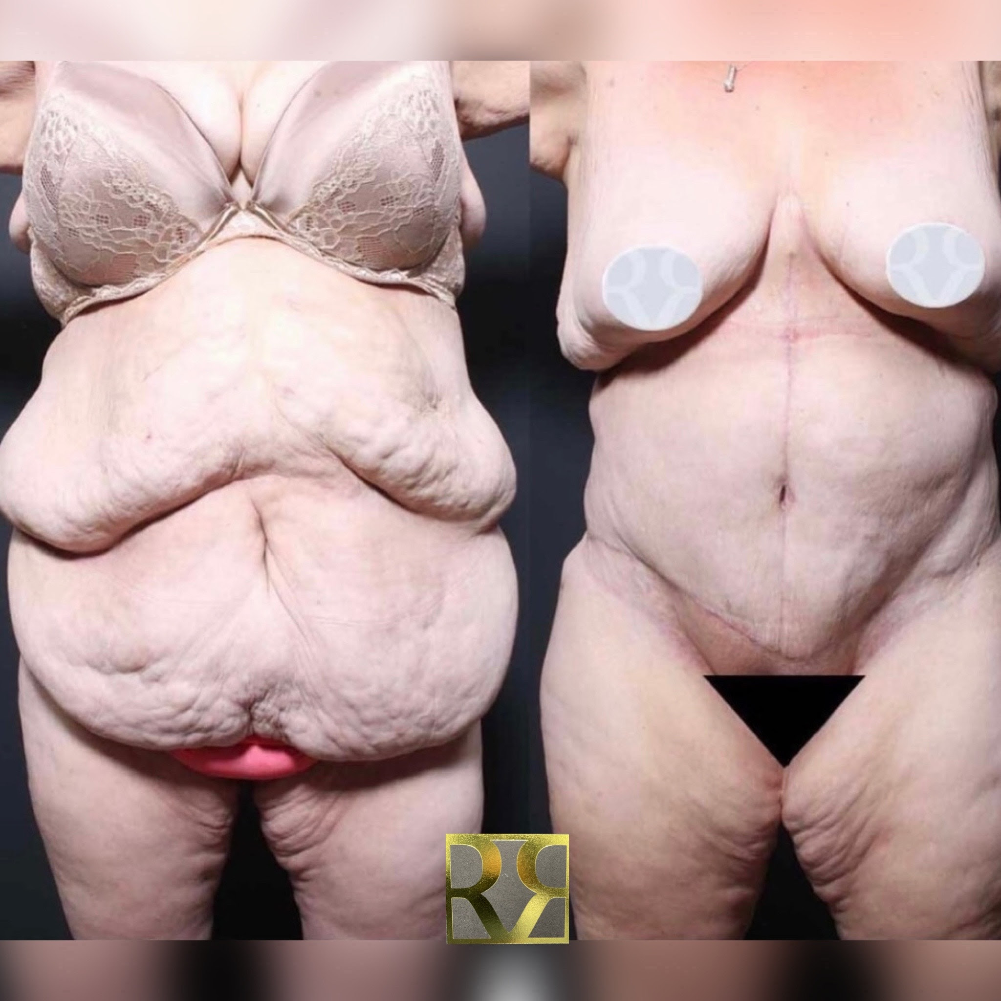 1762876860 1656688808 body lift surgery 1