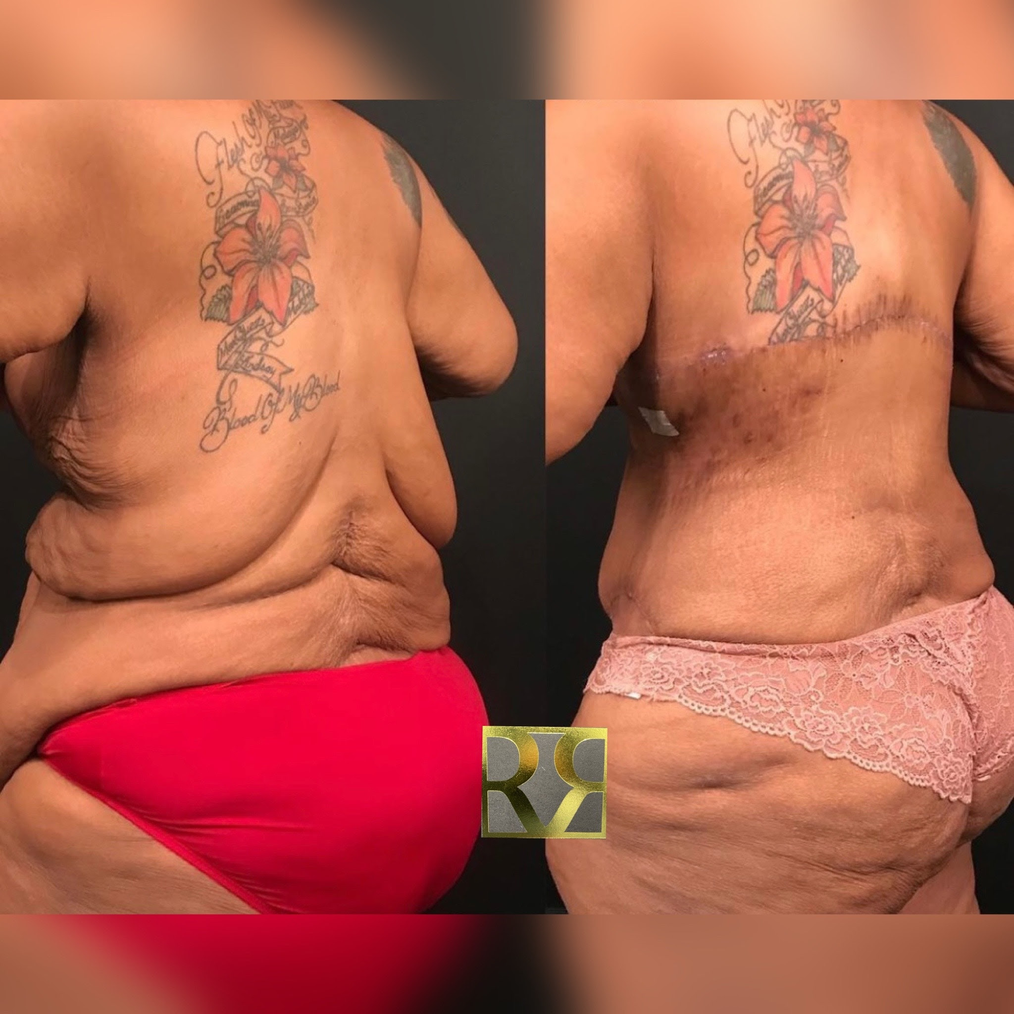 1762876866 1656688799 body lift surery 2 1