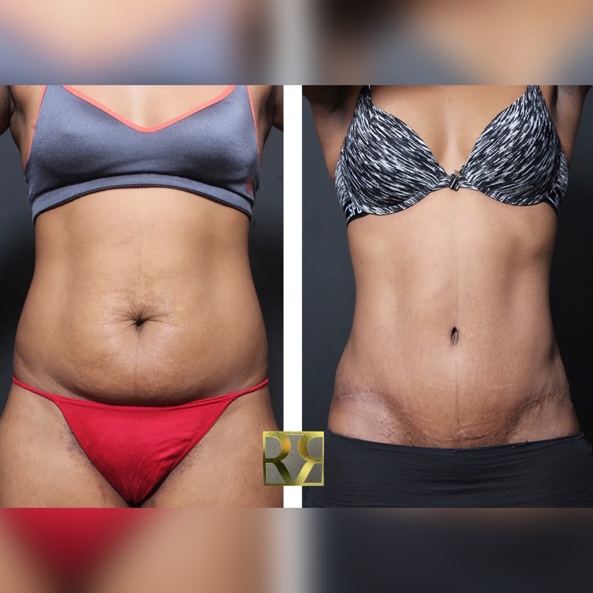 1762876876 1657292318 repta incision scar 1