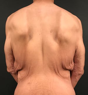 before and after bra line back lift images