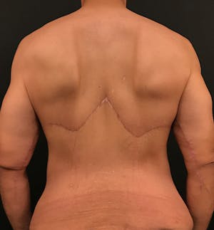 before and after bra line back lift images