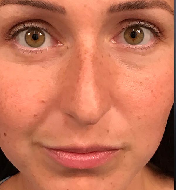 Before Image: Rhinoplasty - front