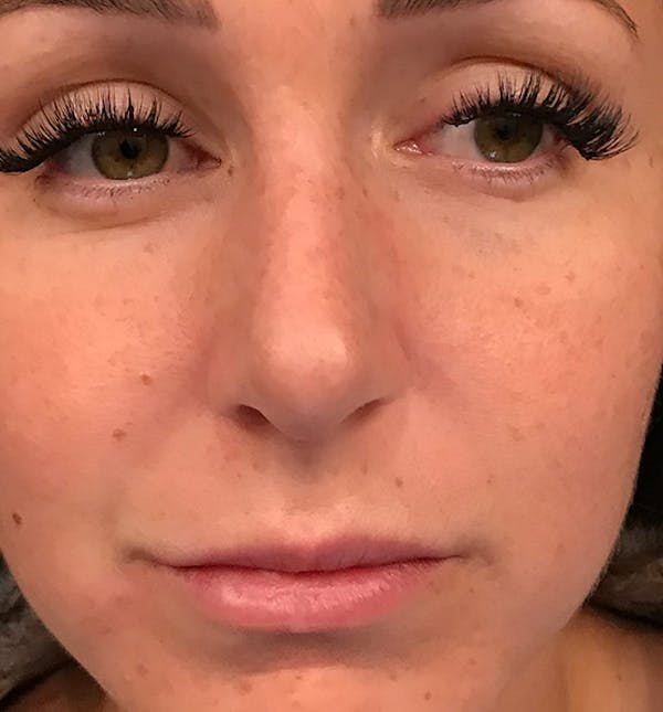 After Image: Rhinoplasty - front