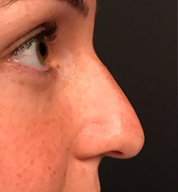 Rhinoplasty