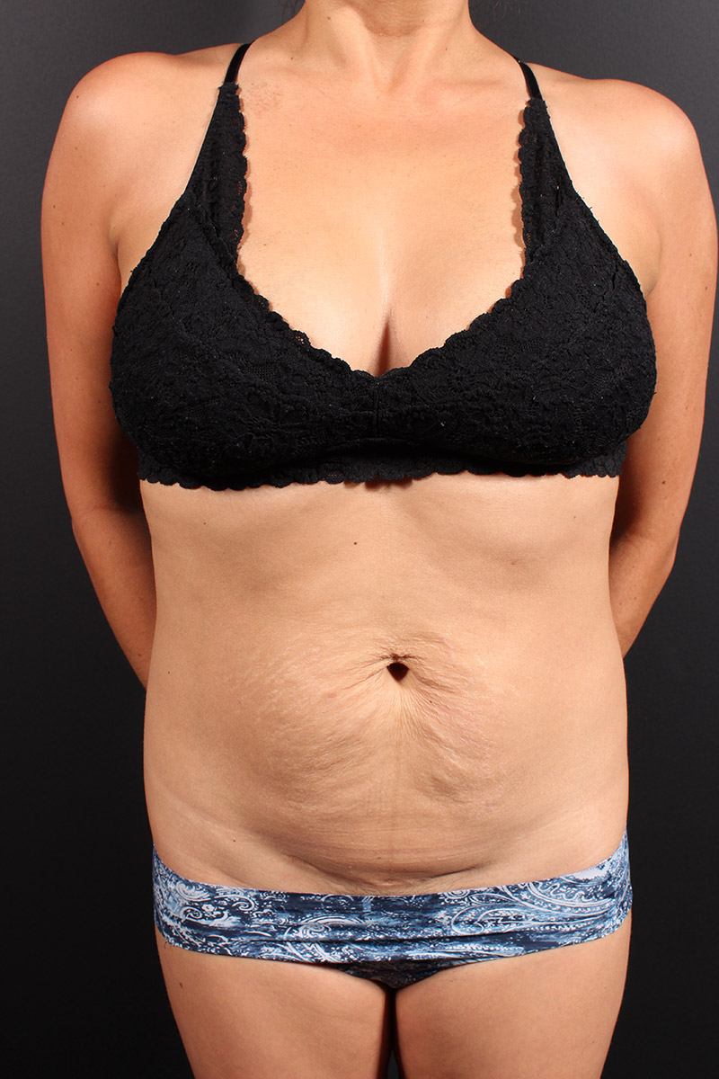 Tummy Tuck
