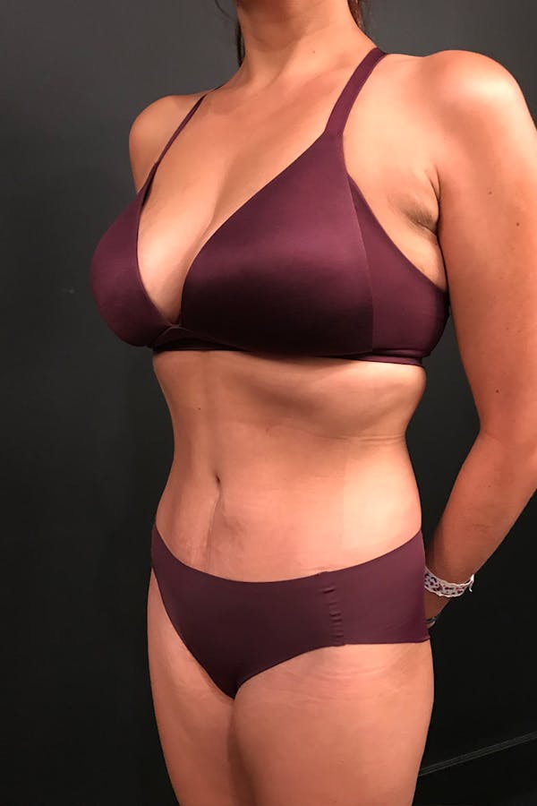 Tummy Tuck