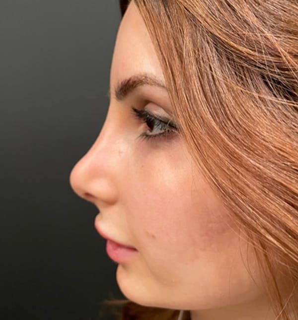 After Image: Rhinoplasty - left-side