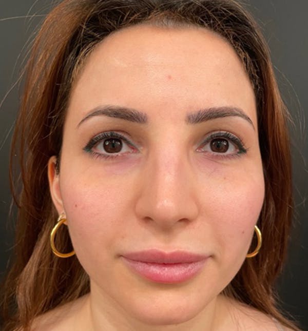 Before Image: Rhinoplasty - front