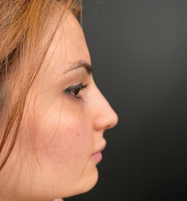 Before Image: Rhinoplasty - right-side