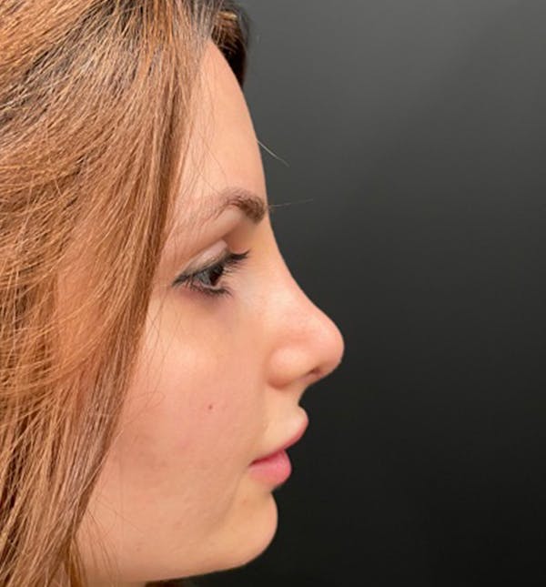 After Image: Rhinoplasty - right-side